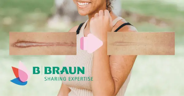 Υπερτροφική Ουλή: Τι είναι και ποιος είναι ο καλύτερος τρόπος αντιμετώπισης