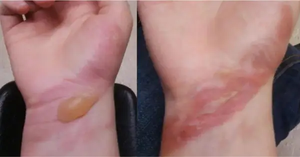 Έγκαυμα Και Πώς Να Το Αντιμετωπίσετε