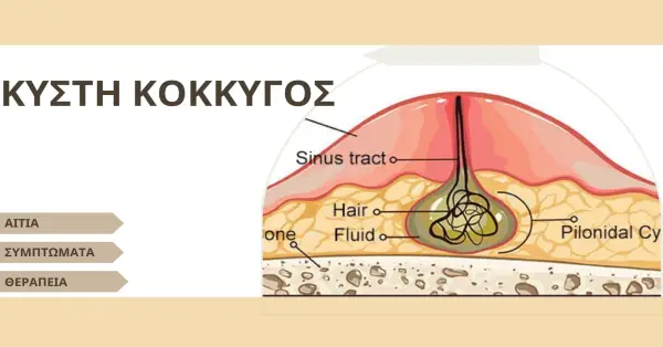 Κύστη Κόκκυγος : Συμπτώματα και Θεραπεία